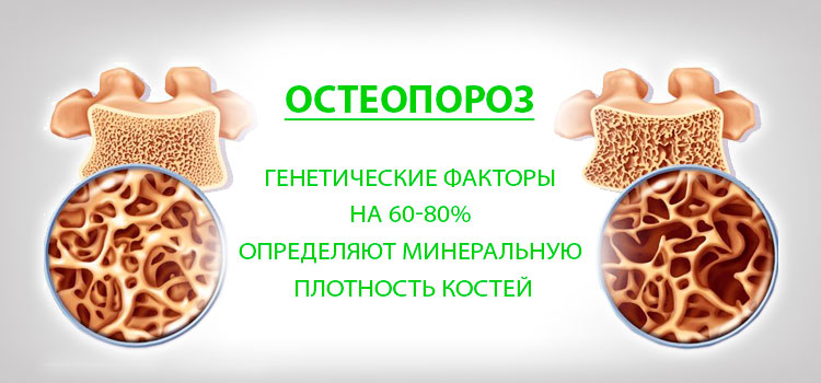 Остеопороз именяет минеральную плотность костей Остеопороз костей