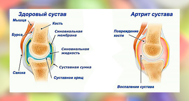 Артрит сустава на рисунке Артрит сустава