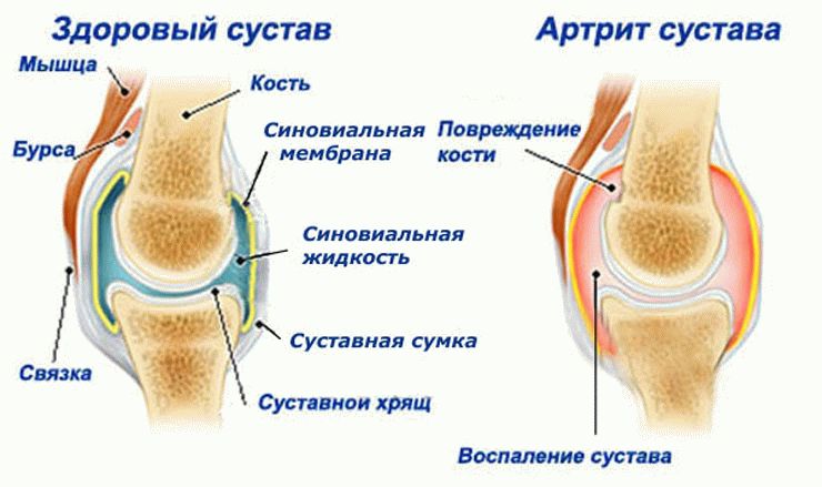 заболевание суставов артрит - заболевание суставов