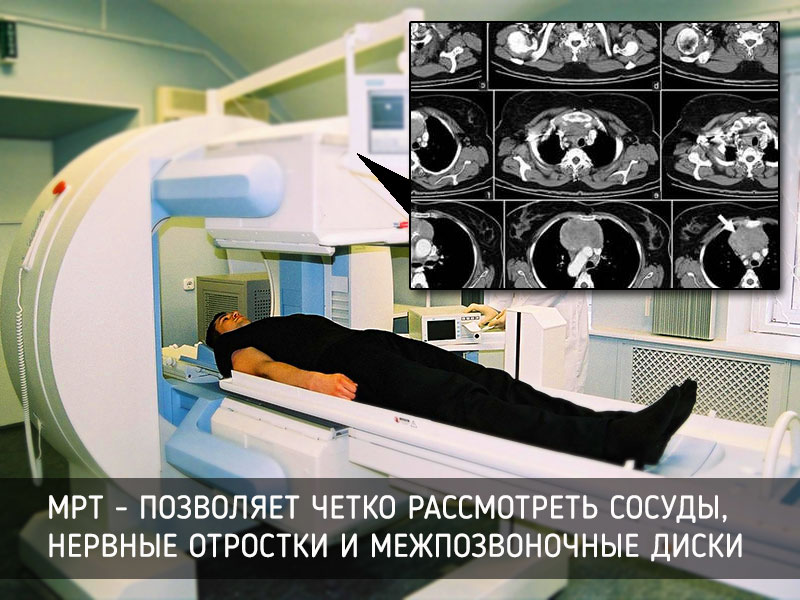 Мрт как метод диагностики при остеохондрозе мрт при остеохондрозе