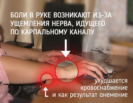 туннельный синдром карпальный туннельный синдром