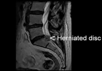 Видео о грыжах межпозвонковых дисков. Строение диска, симптомы грыжи