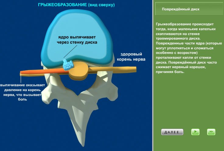 Грыжа межпозвоночного диска