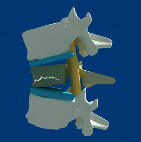 Кифопластика, как способ исправления деформации позвонка