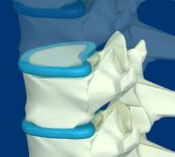 Межпозвонковый (межпозвоночный) диск