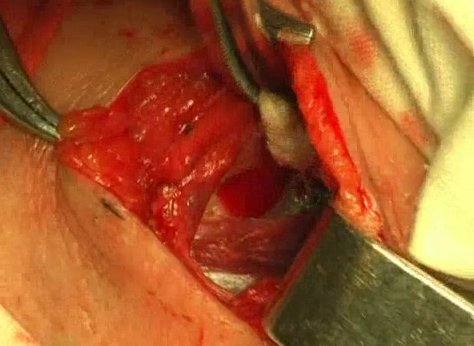 Операции на шейном отделе позвоночника