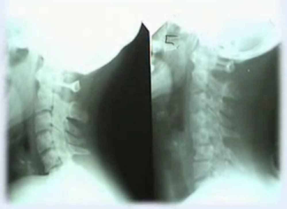 Видео о способах лечения вывиха позвонка