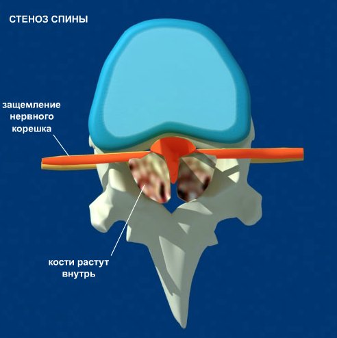 Заболевания позвоночника